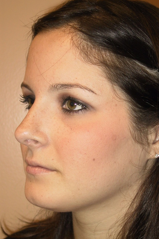 Rhinoplasty-01 | After Rhinoplasty 2