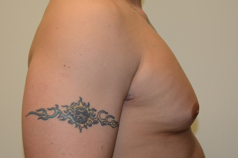 Male-Breast-Reduction-01 | Before Male Breast Reduction 5
