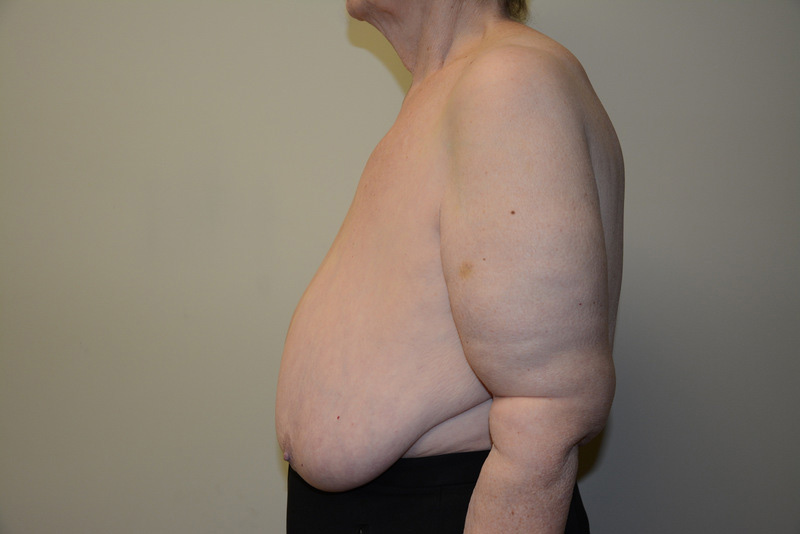 Breast-Reduction-01 | Before Breast Reduction 5