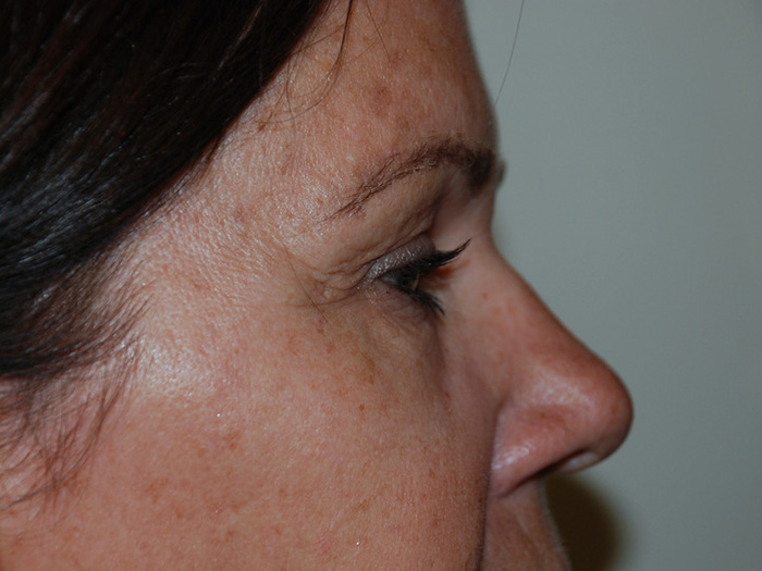 Brow-Lift-01 | Before Brow Lift 3