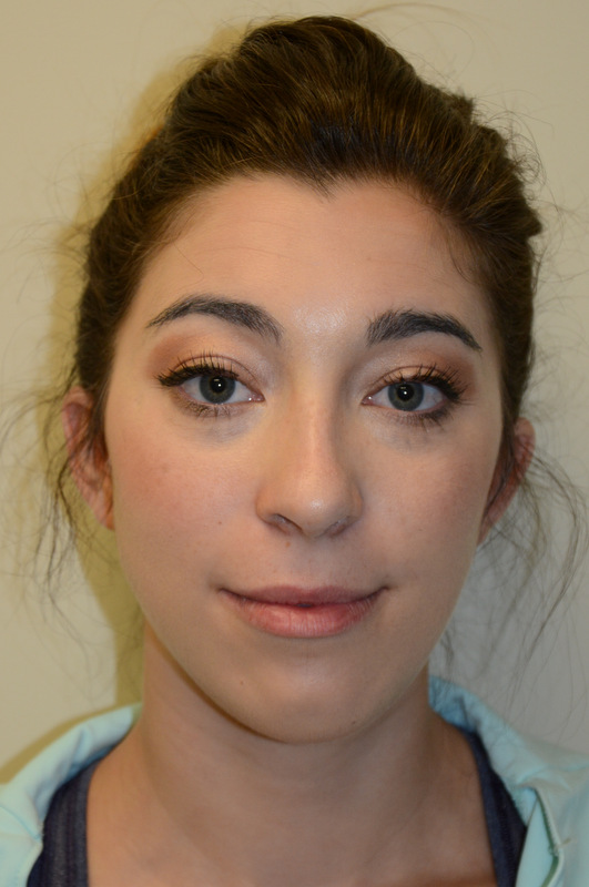 Chin-Augmentation-01 | After Chin Augmentation