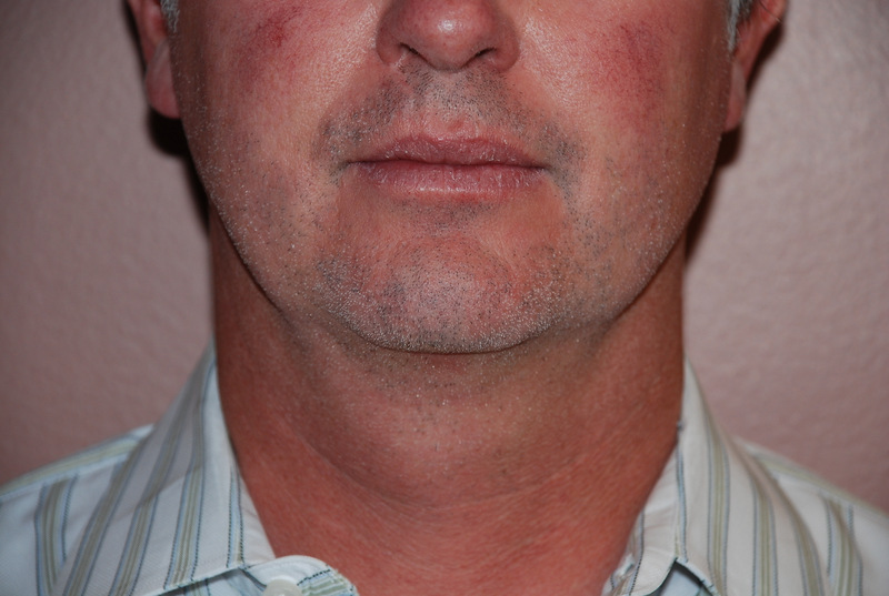 Neck-Liposuction-02 | After Neck Liposuction