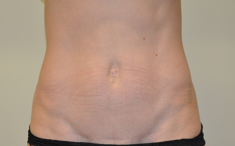 Mini-Tummy-Tuck-01 | After Mini Tummy Tuck 1