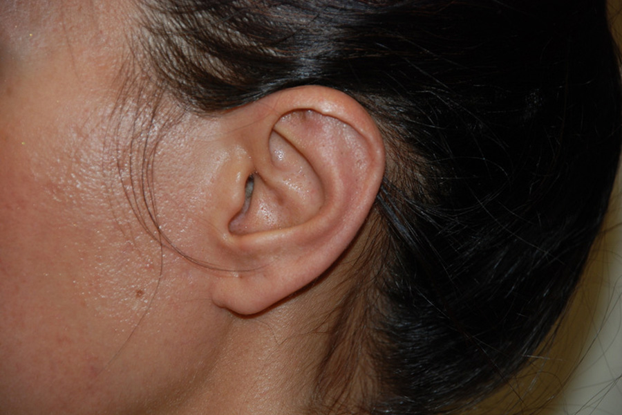 Prominent-Ear-Surgery-01 | After Prominent Ear Surgery 3
