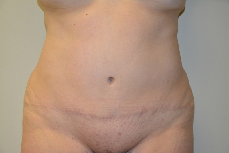 Tummy-Tuck-01 | After Tummy Tuck
