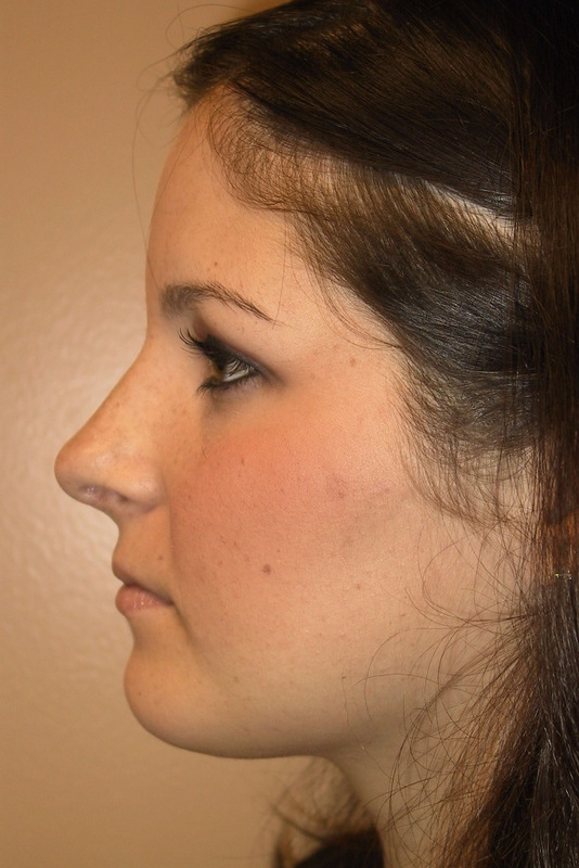 Rhinoplasty-01 | After Rhinoplasty 3