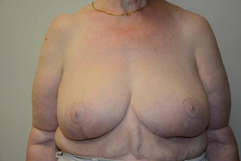 Breast-Reduction-01 | After Breast Reduction