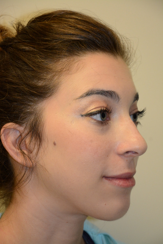 Chin-Augmentation-01 | After Chin Augmentation 2