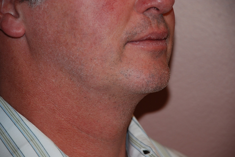 Neck-Liposuction-02 | After Neck Liposuction 2