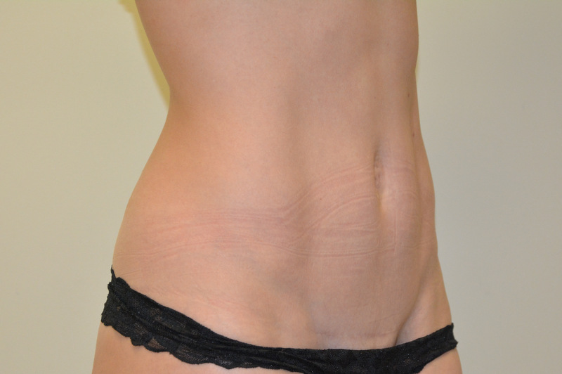 Mini-Tummy-Tuck-01 | After Mini Tummy Tuck 2