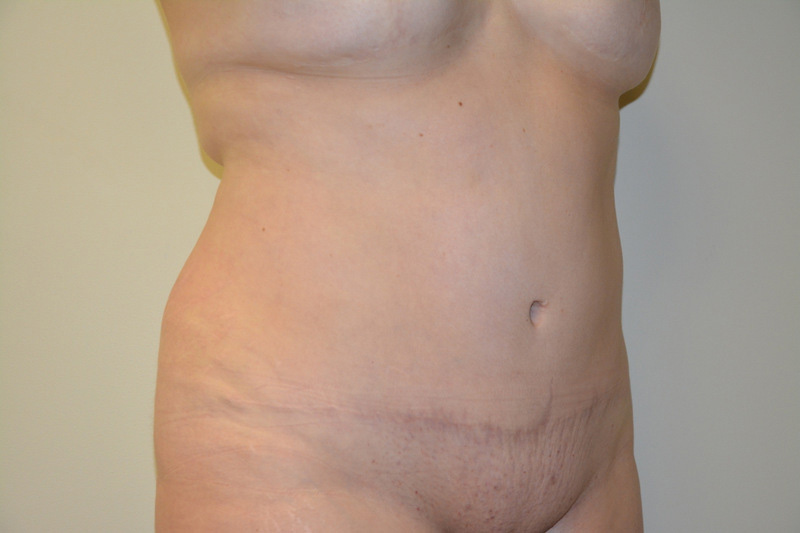 Tummy-Tuck-01 | After Tummy Tuck 4