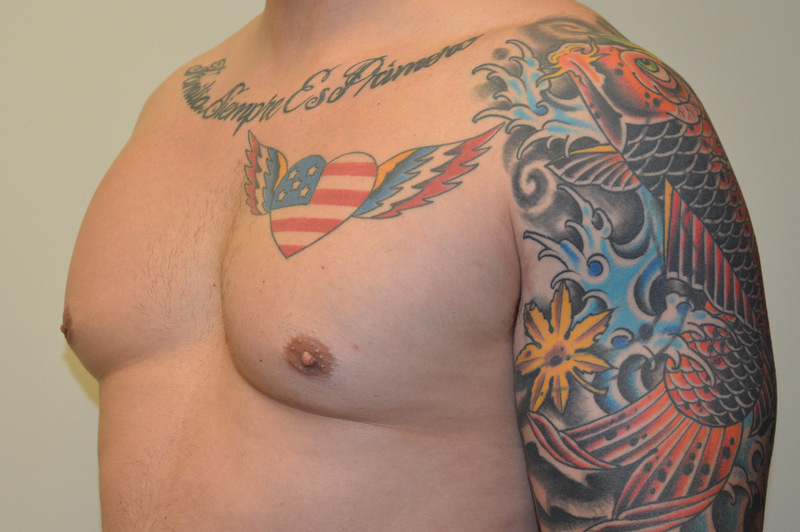 Male-Breast-Reduction-01 | After Male Breast Reduction 2