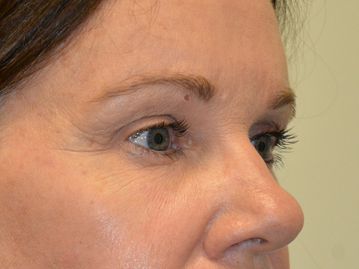 Brow-Lift-01 | After Brow Lift 2