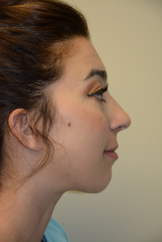 Chin-Augmentation-01 | After Chin Augmentation 3