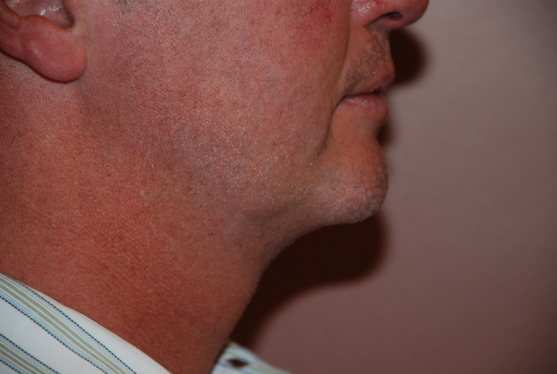 Neck-Liposuction-02 | After Neck Liposuction 4
