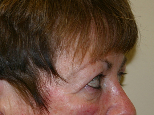 Eyelid-Surgery-02 | After Eyelid Surgery 3