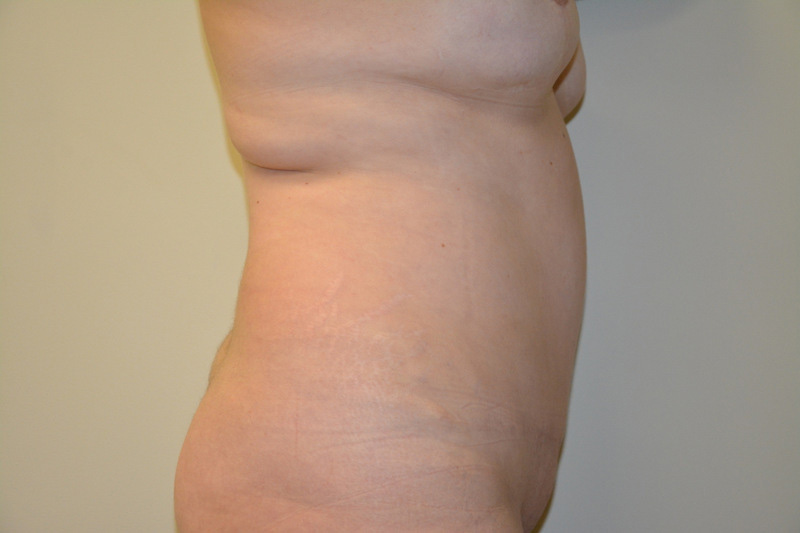 Tummy-Tuck-01 | After Tummy Tuck 5