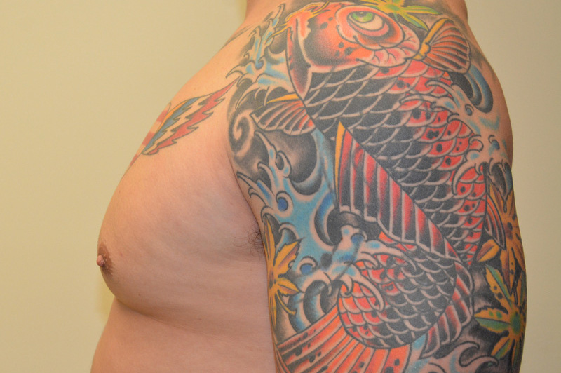 Male-Breast-Reduction-01 | After Male Breast Reduction 3