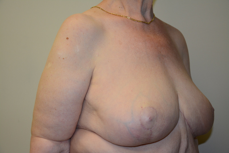 Breast-Reduction-01 | After Breast Reduction 2