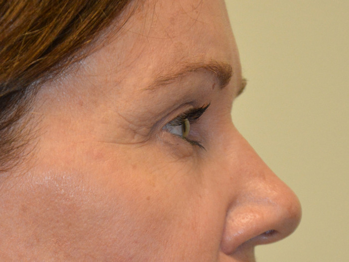 Brow-Lift-01 | After Brow Lift 3