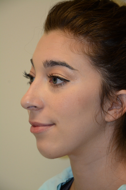 Chin-Augmentation-01 | After Chin Augmentation 4