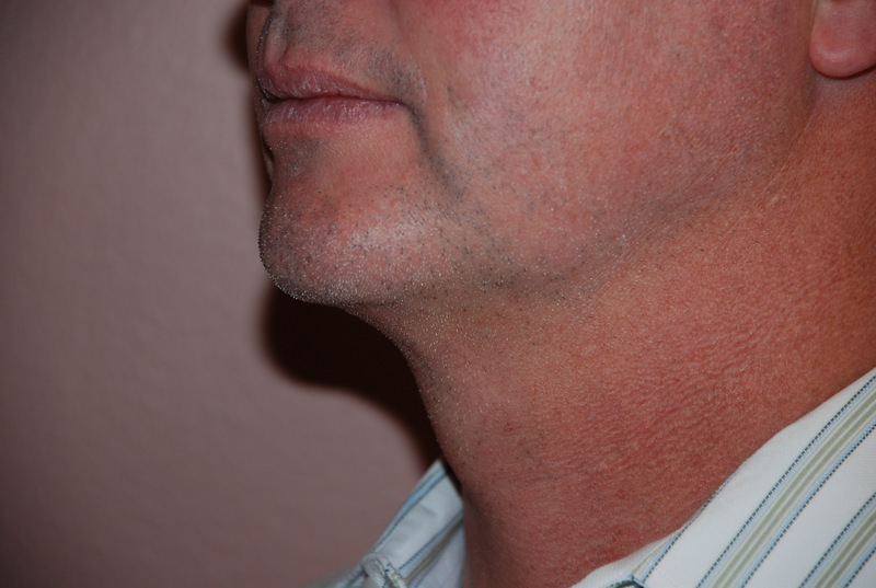 Neck-Liposuction-02 | After Neck Liposuction 3