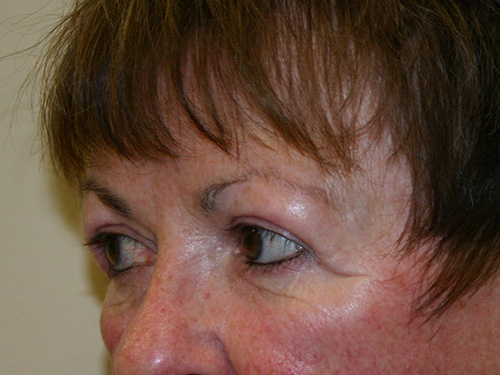 Eyelid-Surgery-02 | After Eyelid Surgery 4