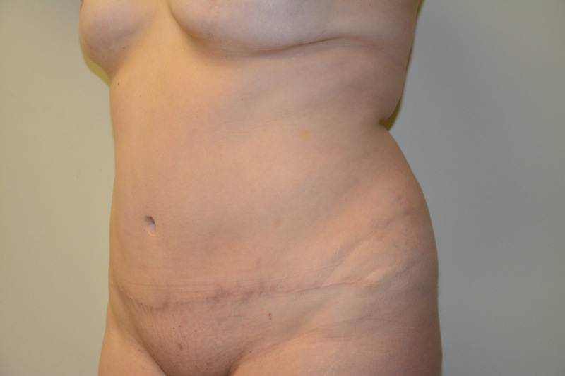 Tummy-Tuck-01 | After Tummy Tuck 2