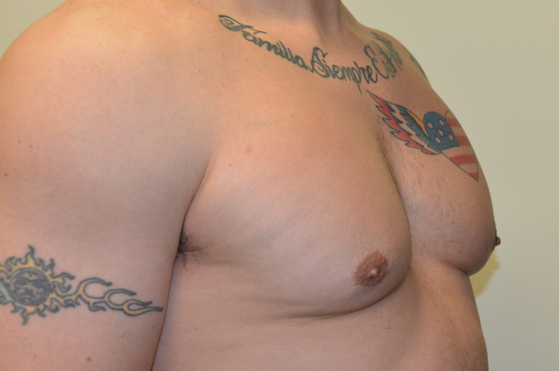 Male-Breast-Reduction-01 | After Male Breast Reduction 4