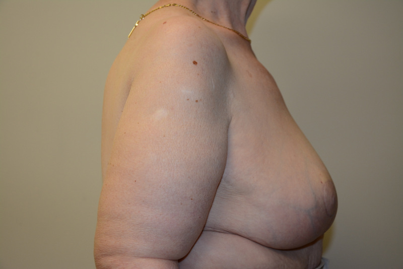 Breast-Reduction-01 | After Breast Reduction 3