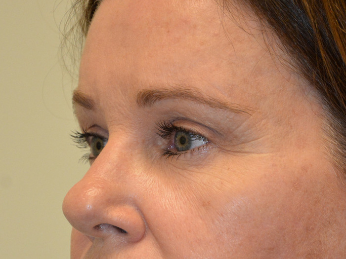 Brow-Lift-01 | After Brow Lift 4