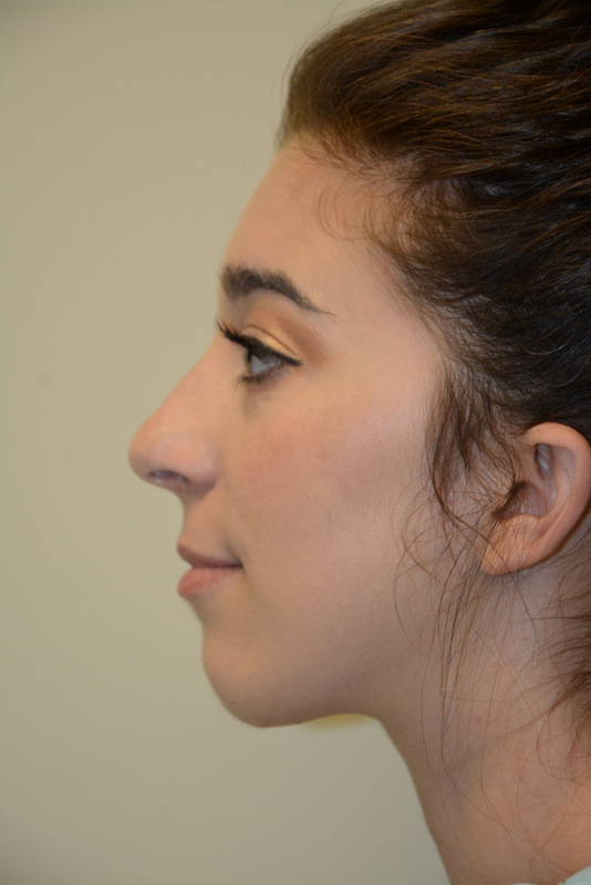 Chin-Augmentation-01 | After Chin Augmentation 5