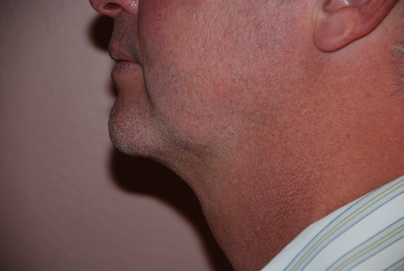 Neck-Liposuction-02 | After Neck Liposuction 5