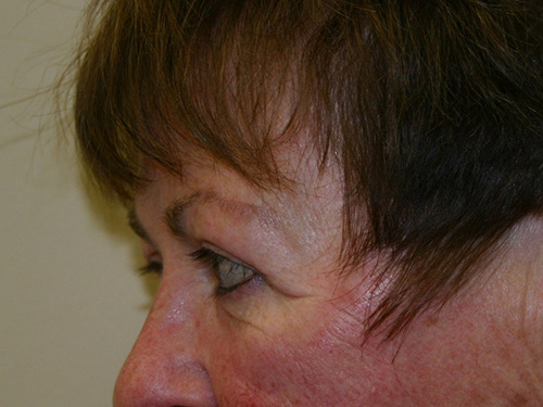 Eyelid-Surgery-02 | After Eyelid Surgery 5