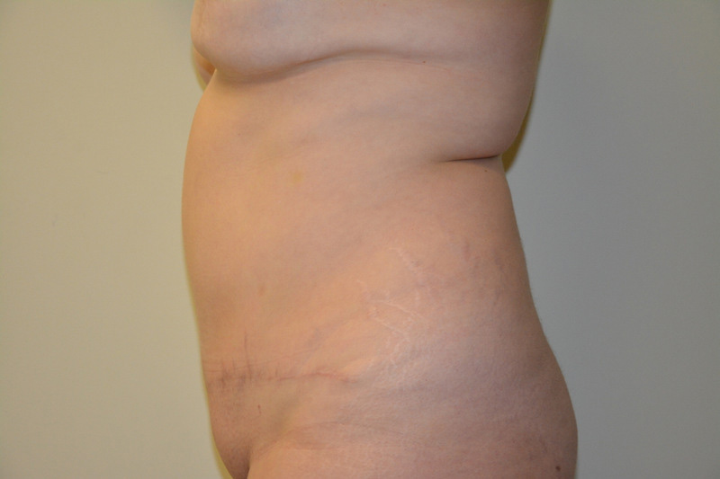Tummy-Tuck-01 | After Tummy Tuck 3