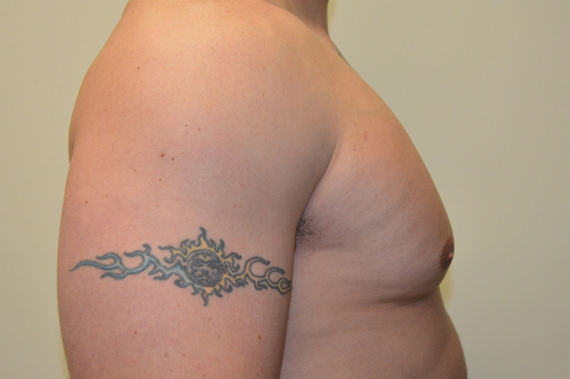 Male-Breast-Reduction-01 | After Male Breast Reduction 5