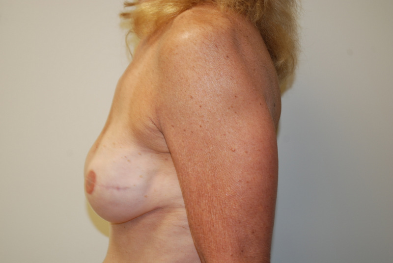 Breast-Reconstruction-Immediate-Implant-01 | After Breast Reconstruction Immediate Implant 5