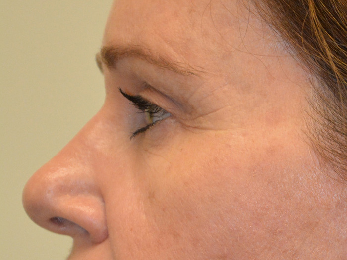 Brow-Lift-01 | After Brow Lift 5
