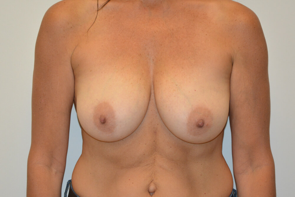 Breast-Reduction-18 | Before Breast Reduction