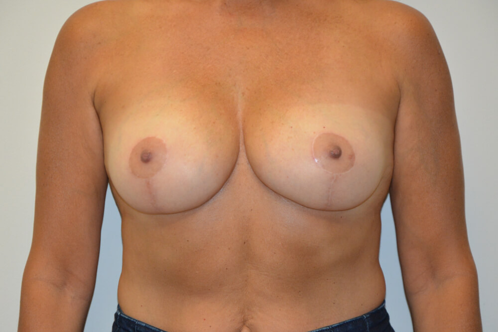 Breast-Reduction-18 | After Breast Reduction