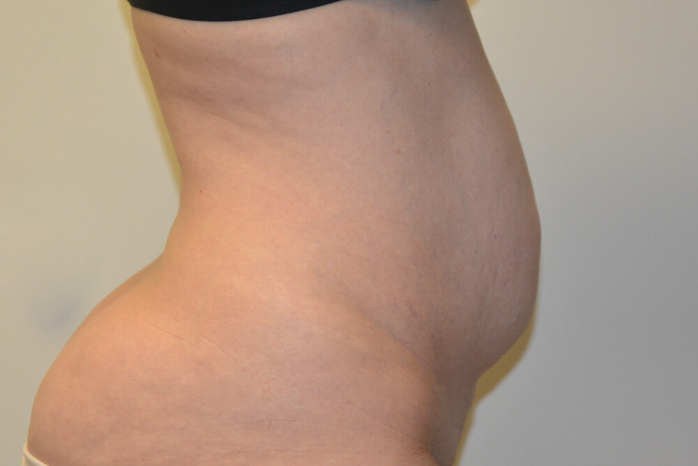 Tummy-Tuck-30 | Before Tummy Tuck 3
