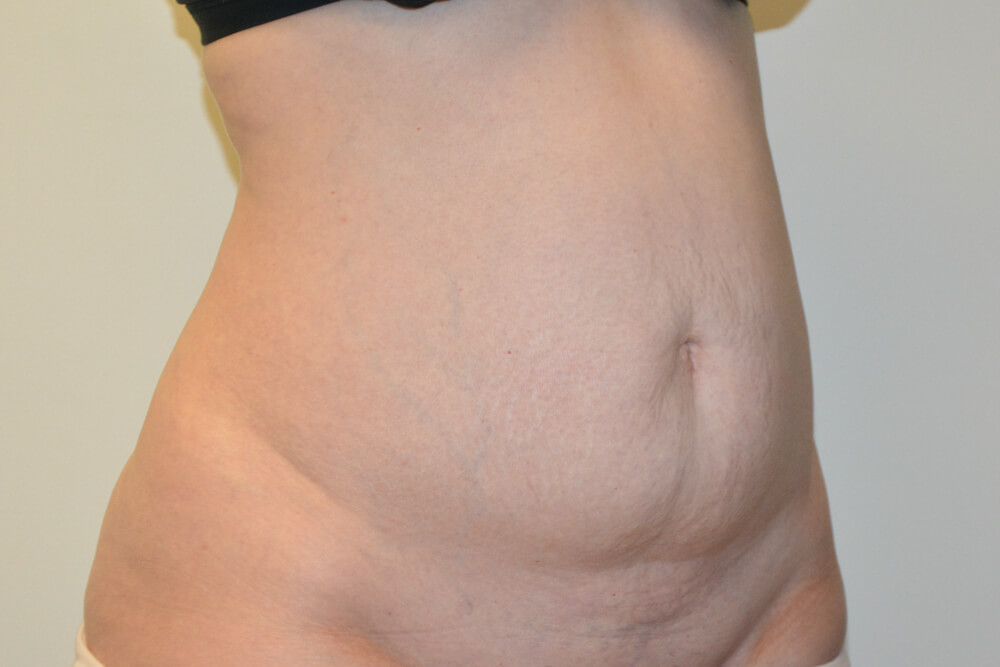 Tummy-Tuck-30 | Before Tummy Tuck 2