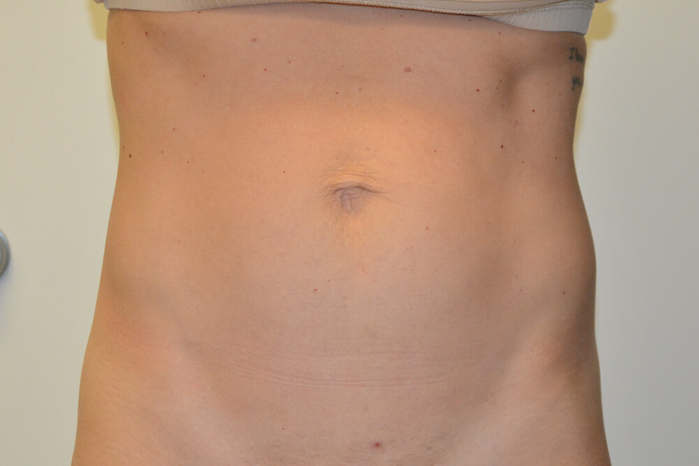 Mini-Tummy-Tuck-09 | Before Mini Tummy Tuck 1