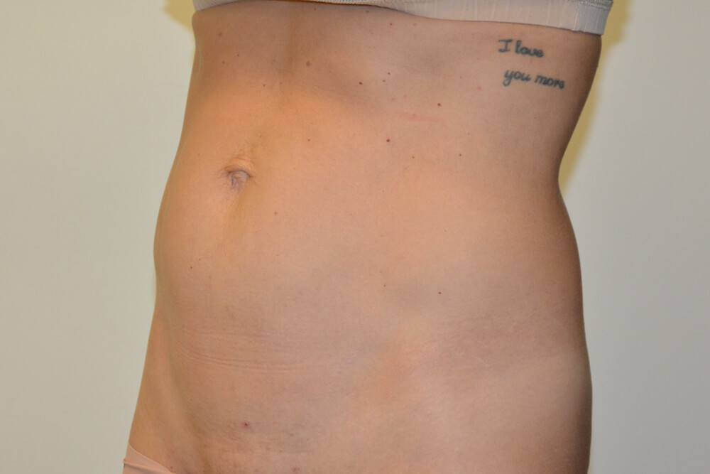 Mini-Tummy-Tuck-09 | Before Mini Tummy Tuck 4