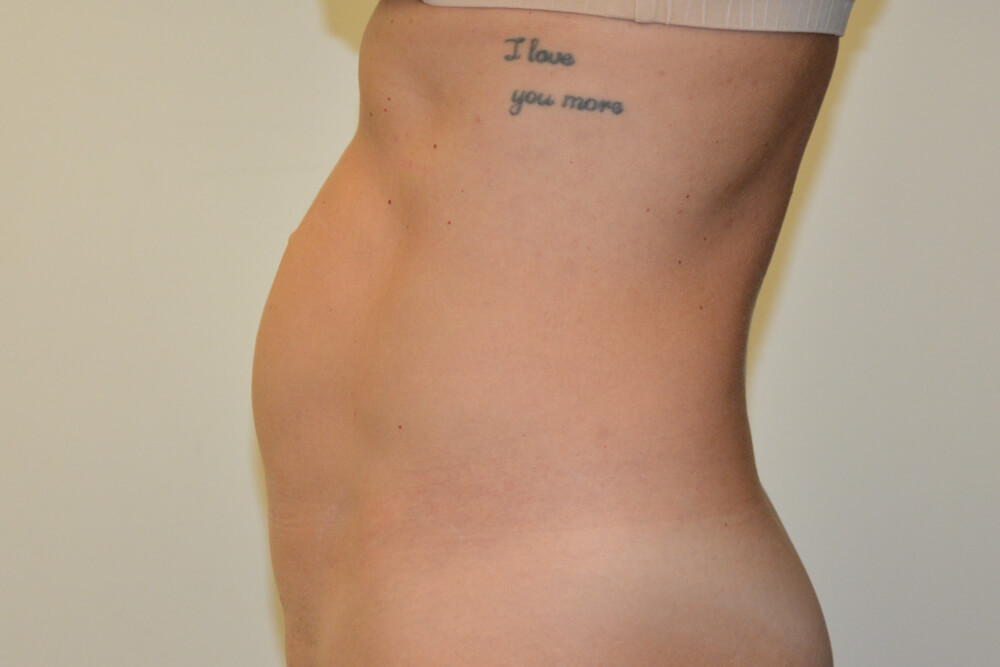 Mini-Tummy-Tuck-09 | Before Mini Tummy Tuck 5