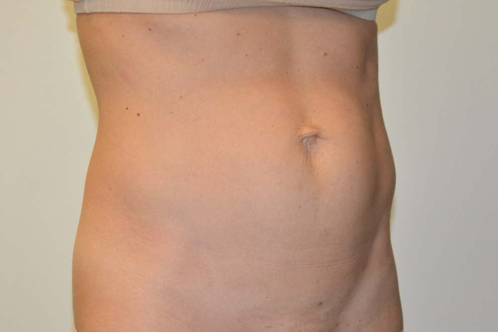 Mini-Tummy-Tuck-09 | Before Mini Tummy Tuck 2