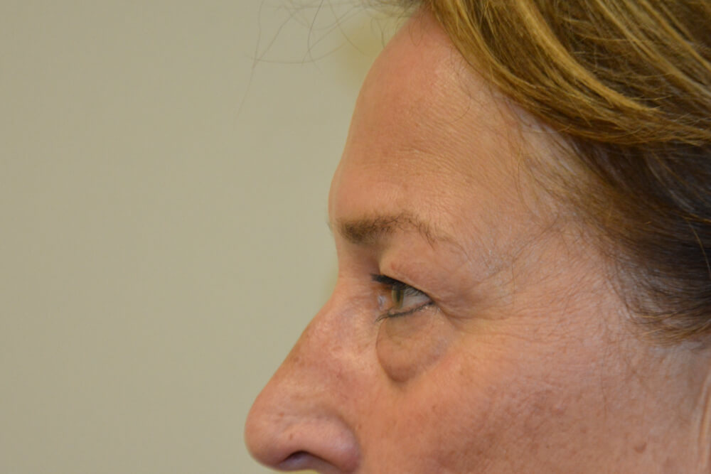 Eyelid-Surgery-13 | Before Eyelid Surgery 5