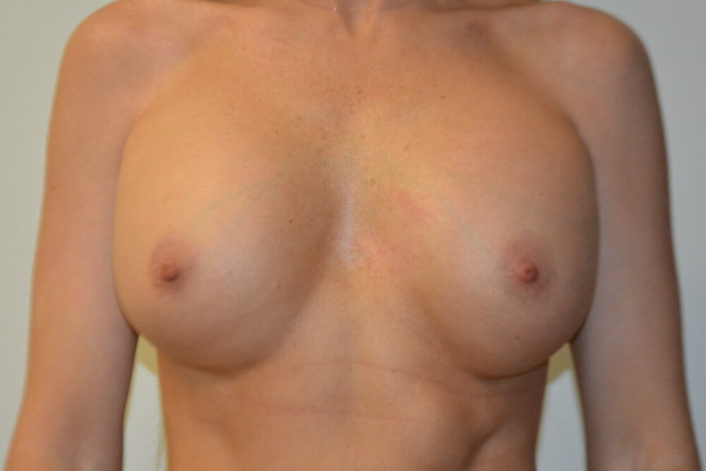 Breast-Revision-25 | Before Breast Revision