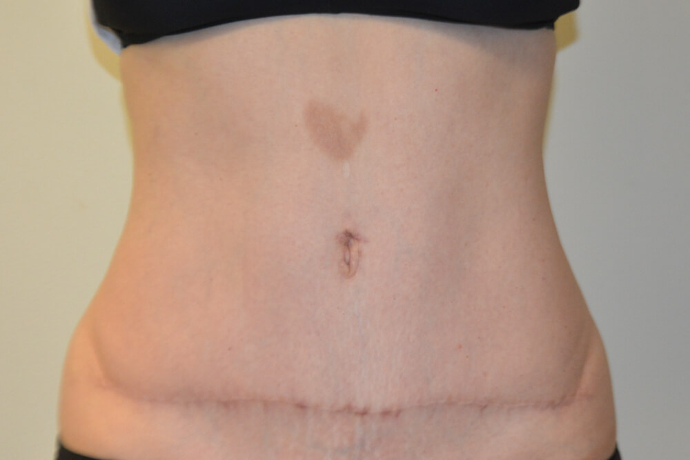 Tummy-Tuck-30 | After Tummy Tuck