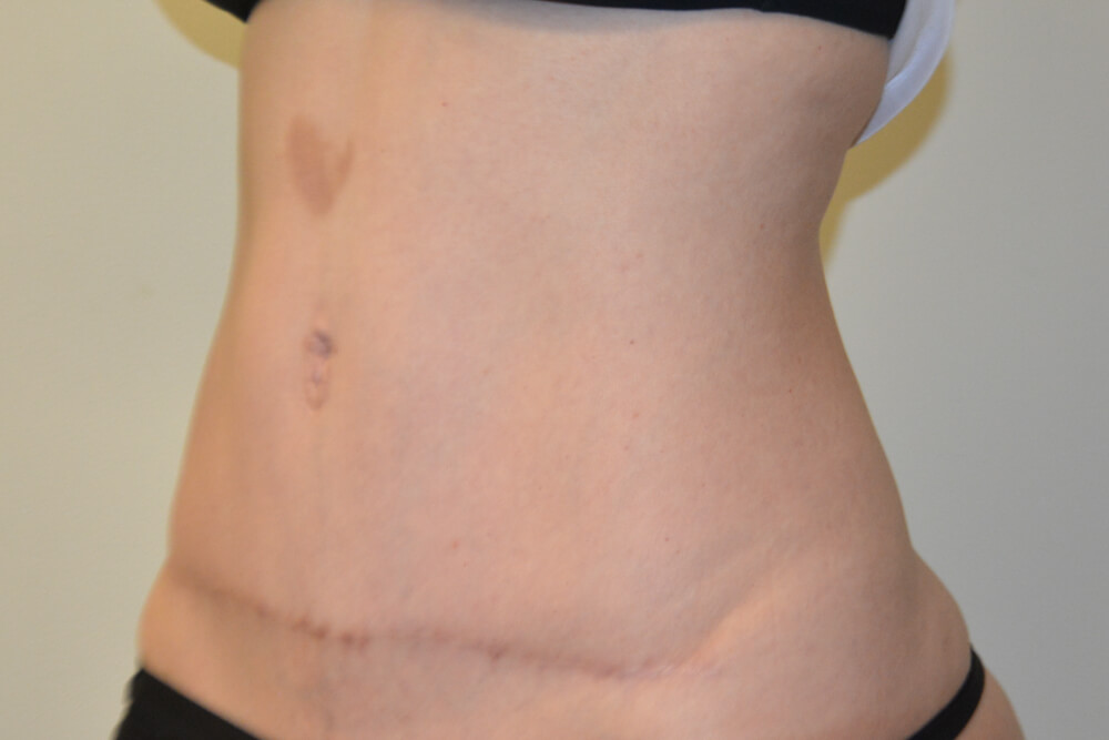 Tummy-Tuck-30 | After Tummy Tuck 4